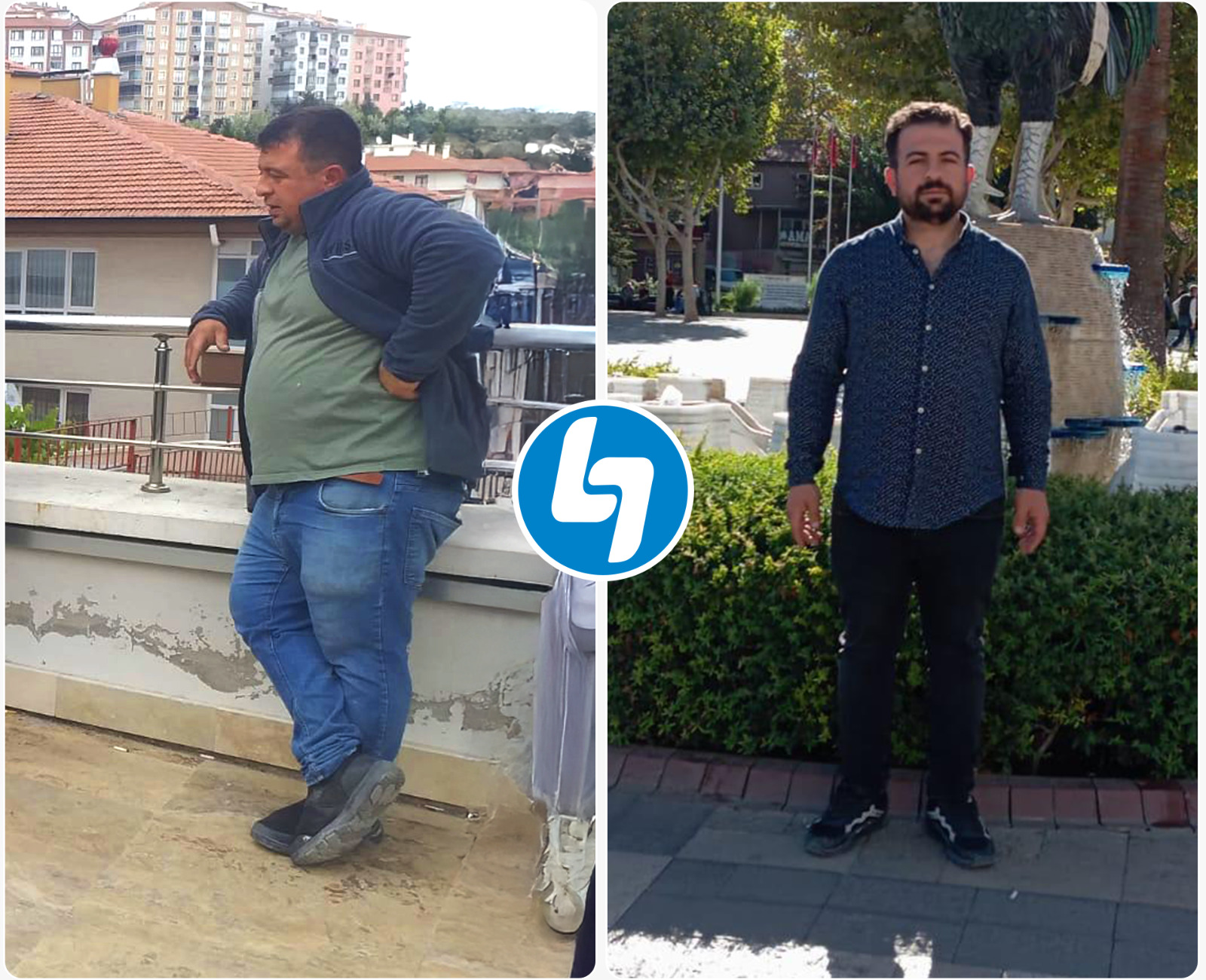 Gastric bypass surgery